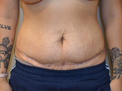 Tummy Tuck Before & After Gallery - Patient 111684 - Image 2