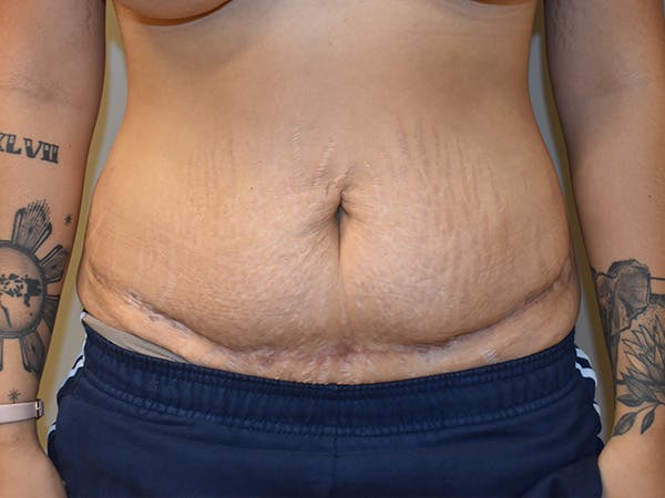 Tummy Tuck Before & After Gallery - Patient 111684 - Image 2