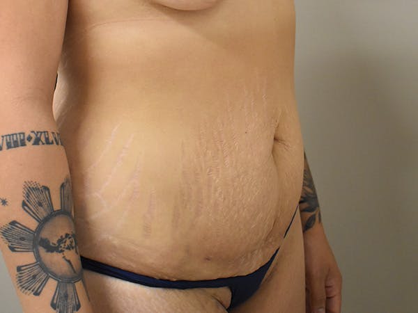 Tummy Tuck Before & After Gallery - Patient 111684 - Image 3