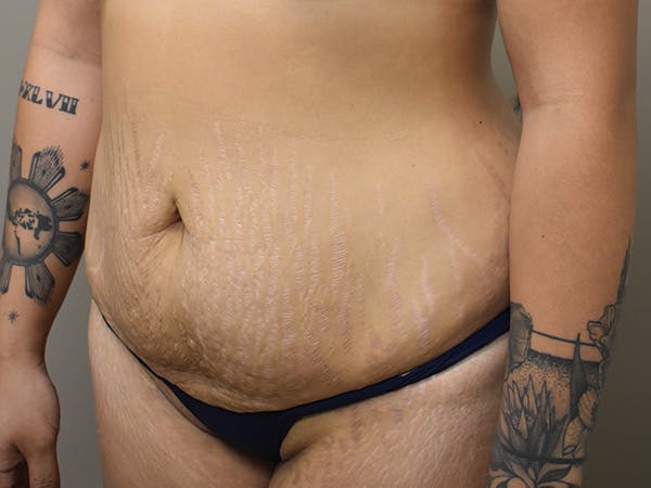 Tummy Tuck Before & After Gallery - Patient 111684 - Image 7