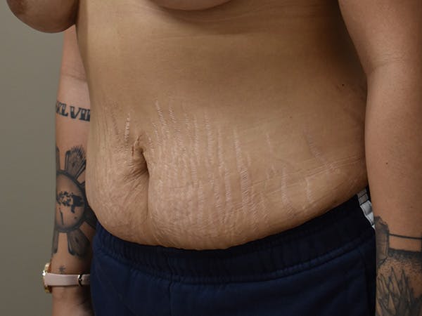 Tummy Tuck Before & After Gallery - Patient 111684 - Image 8