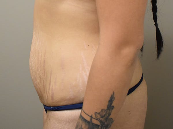 Tummy Tuck Before & After Gallery - Patient 111684 - Image 9