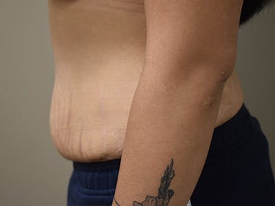 Tummy Tuck Before & After Gallery - Patient 111684 - Image 10