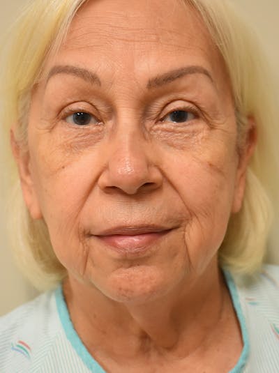 Facelift Before & After Gallery - Patient 133116 - Image 1