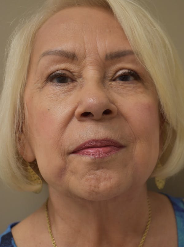 Facelift Before & After Gallery - Patient 133116 - Image 2