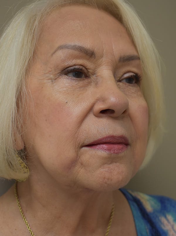 Facelift Before & After Gallery - Patient 133116 - Image 4