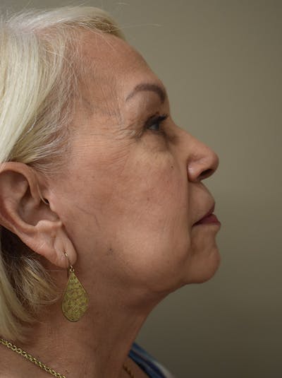 Facelift Before & After Gallery - Patient 133116 - Image 6