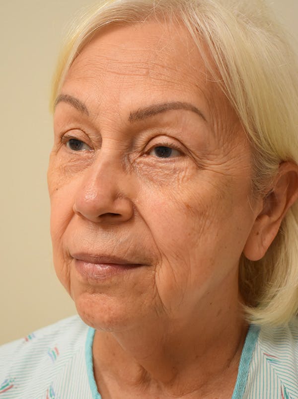 Facelift Before & After Gallery - Patient 133116 - Image 7