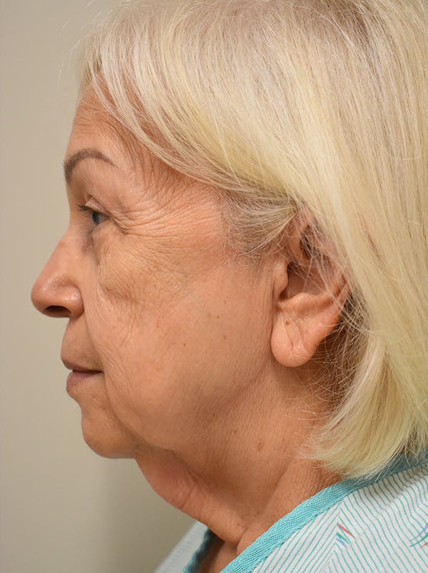 Facelift Before & After Gallery - Patient 133116 - Image 9