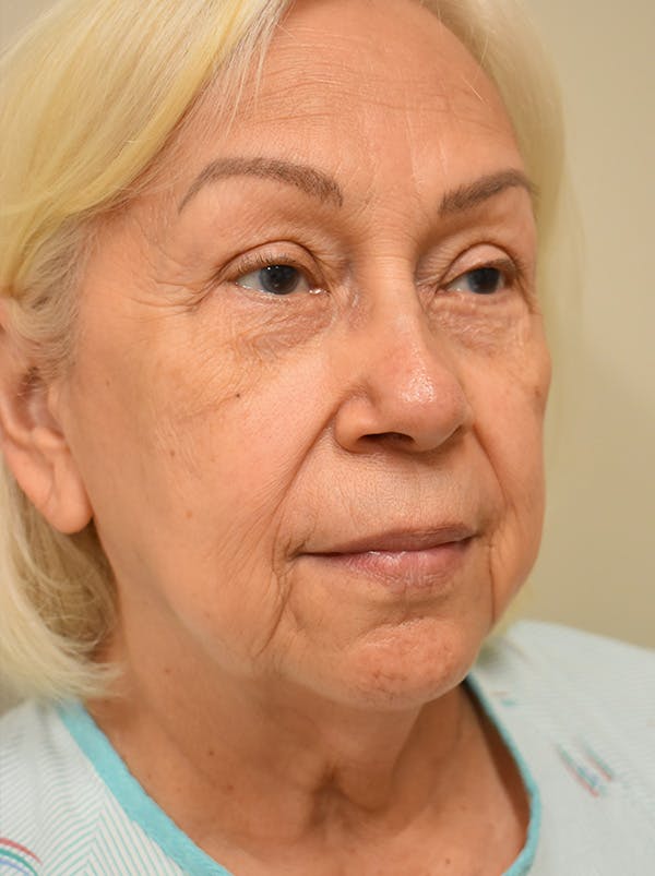 Facelift Before & After Gallery - Patient 133116 - Image 3