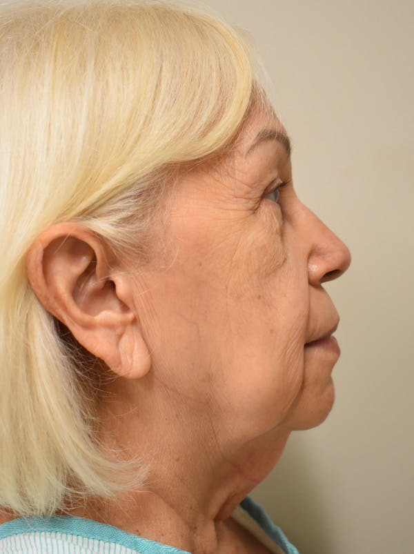 Facelift Before & After Gallery - Patient 133116 - Image 5
