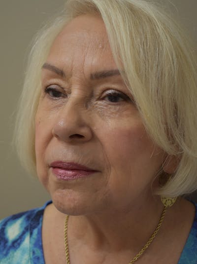 Facelift Before & After Gallery - Patient 133116 - Image 8