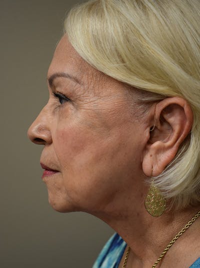 Facelift Before & After Gallery - Patient 133116 - Image 10