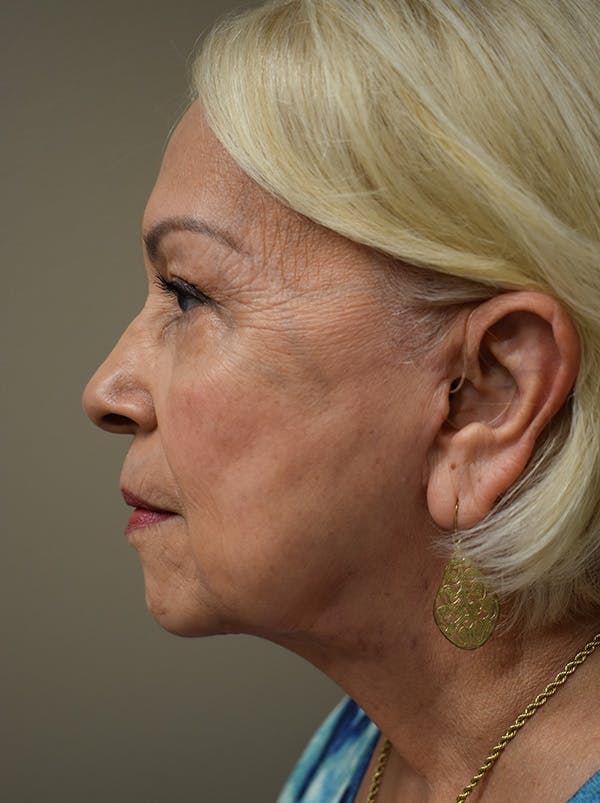 Facelift Before & After Gallery - Patient 133116 - Image 10