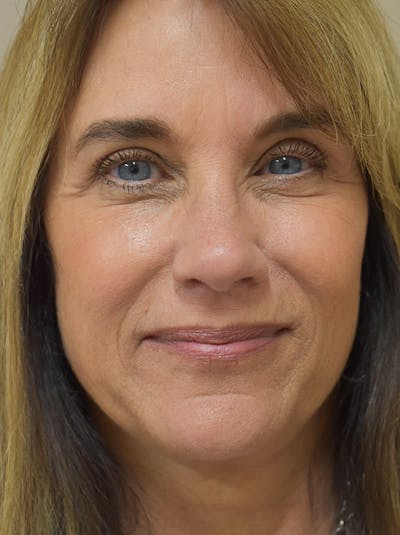 Facelift Before & After Gallery - Patient 199666 - Image 2