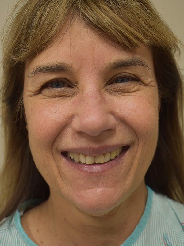 Facelift Before & After Gallery - Patient 199666 - Image 3