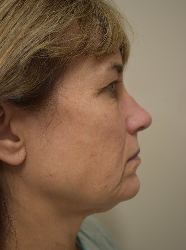 Facelift Before & After Gallery - Patient 199666 - Image 7