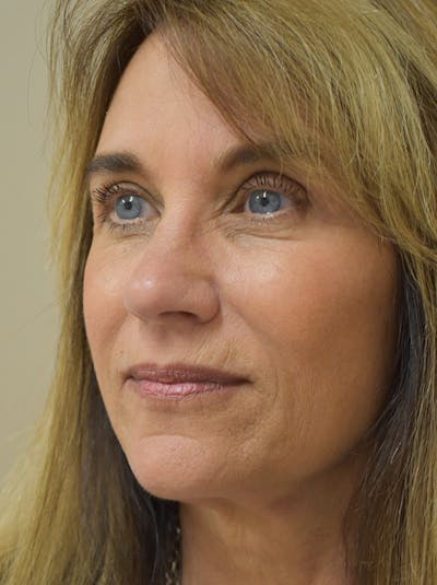 Facelift Before & After Gallery - Patient 199666 - Image 10