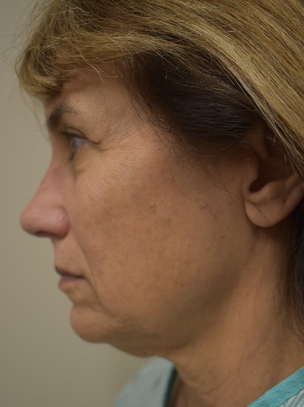Facelift Before & After Gallery - Patient 199666 - Image 11