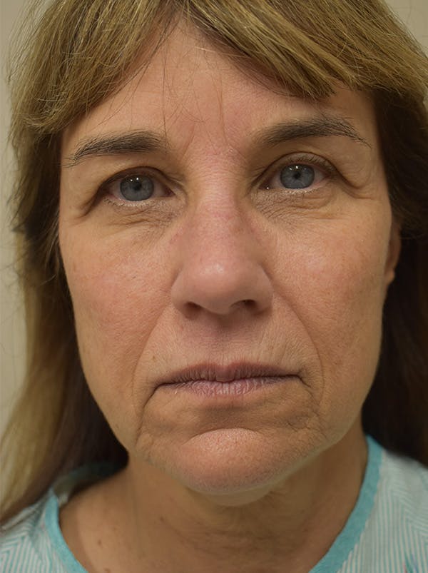 Facelift Before & After Gallery - Patient 199666 - Image 1
