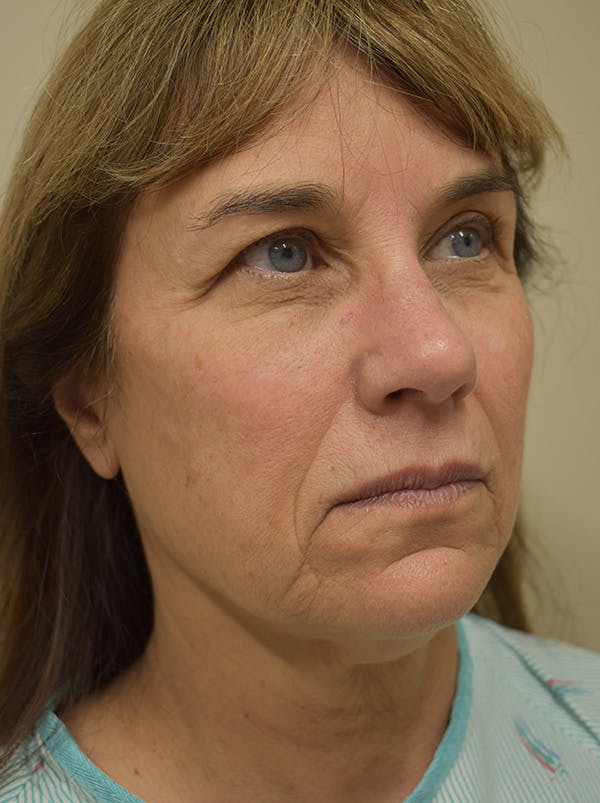 Facelift Before & After Gallery - Patient 199666 - Image 5