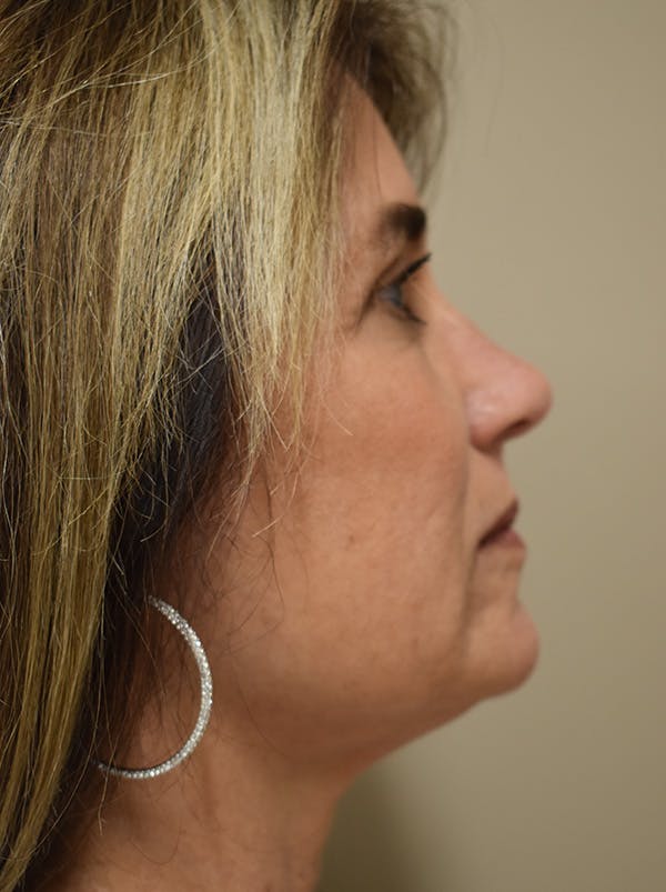 Facelift Before & After Gallery - Patient 199666 - Image 8