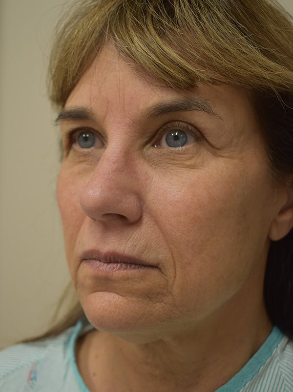 Facelift Before & After Gallery - Patient 199666 - Image 9
