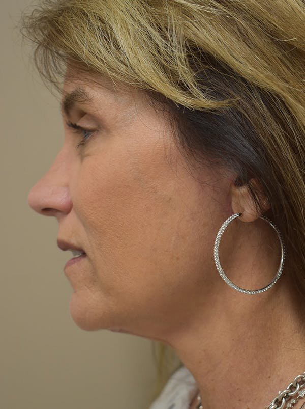 Facelift Before & After Gallery - Patient 199666 - Image 12