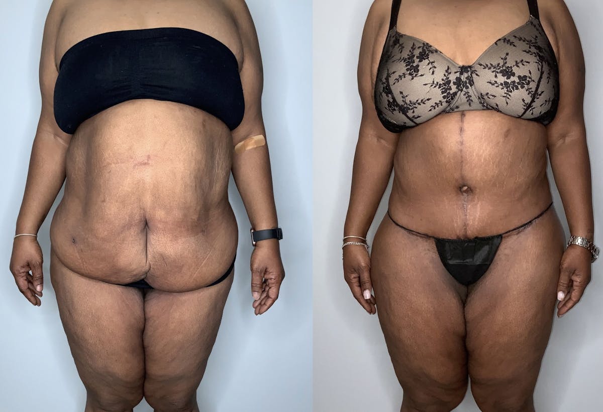 Fleur de lis Abdominoplasty  Before & After Gallery - Patient 64669834 - Image 1