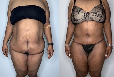 Fleur de lis Abdominoplasty Before & After Gallery - Patient 64669834 - Image 1