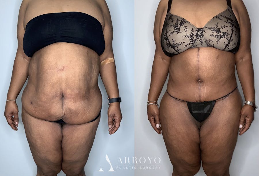 Fleur de lis Abdominoplasty Before & After Gallery - Patient 64669834 - Image 1