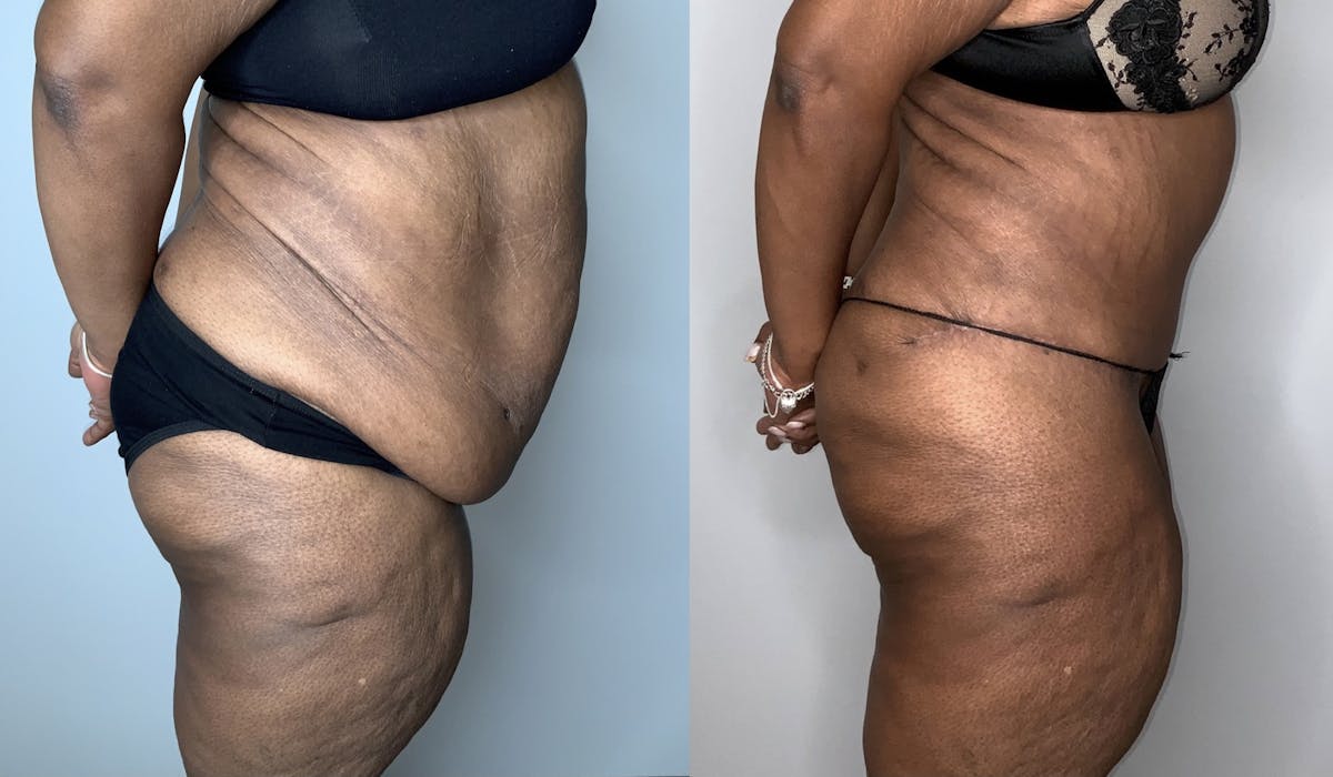 Fleur de lis Abdominoplasty  Before & After Gallery - Patient 64669834 - Image 2