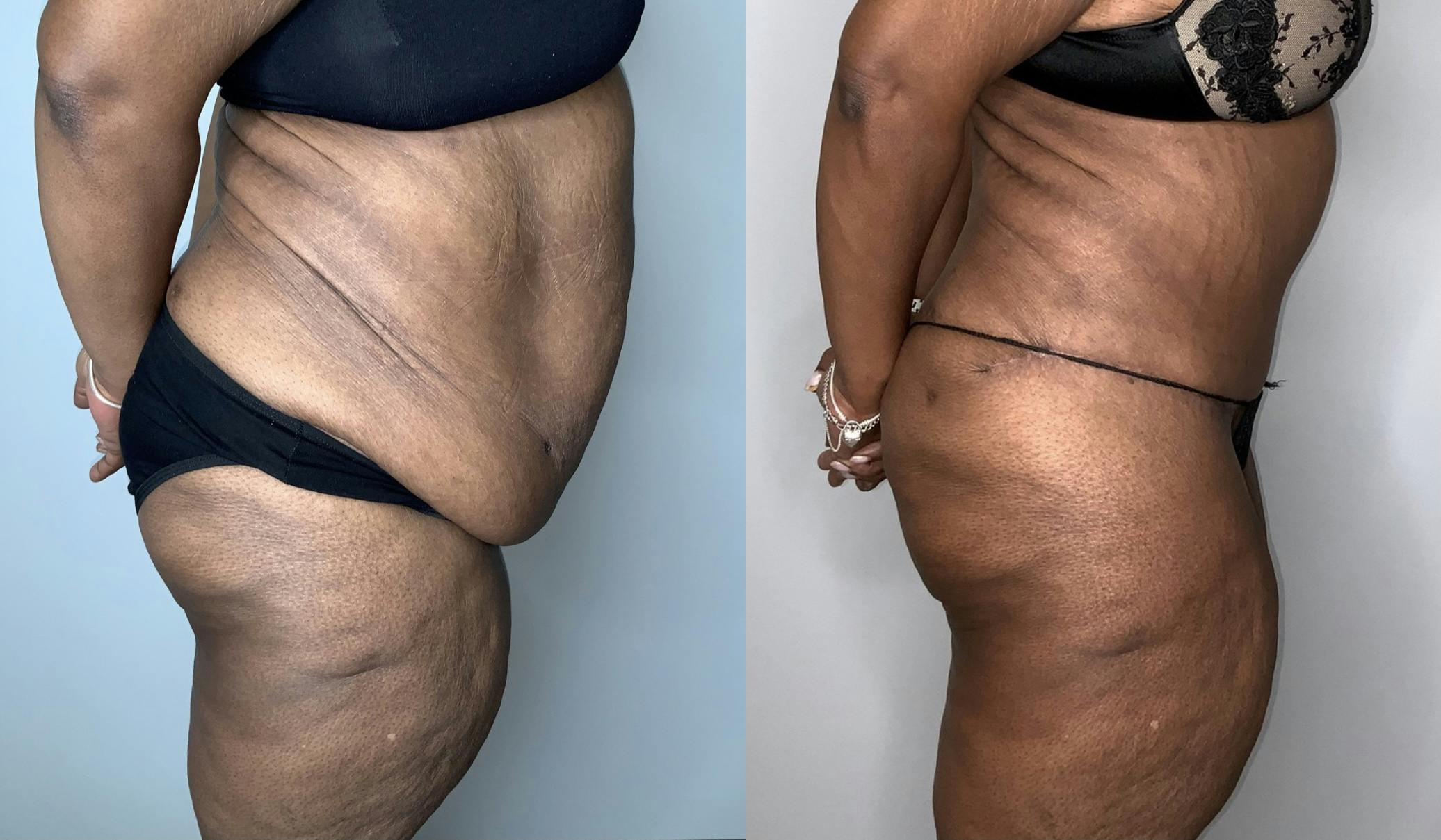 Fleur de lis Abdominoplasty  Before & After Gallery - Patient 64669834 - Image 2