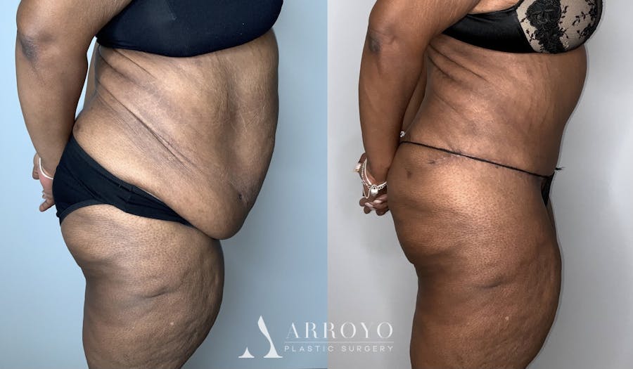 Fleur de lis Abdominoplasty Before & After Gallery - Patient 64669834 - Image 2