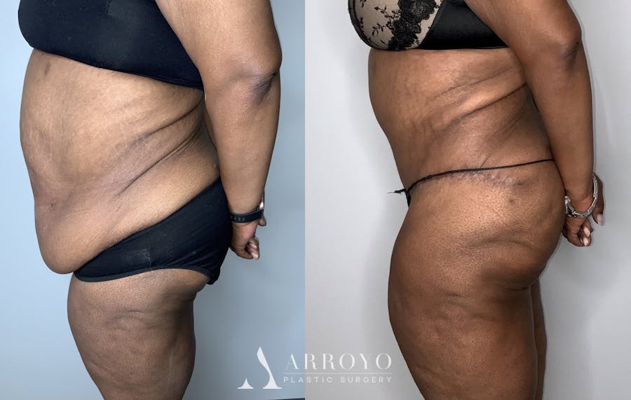 Fleur de lis Abdominoplasty Before & After Gallery - Patient 64669834 - Image 3