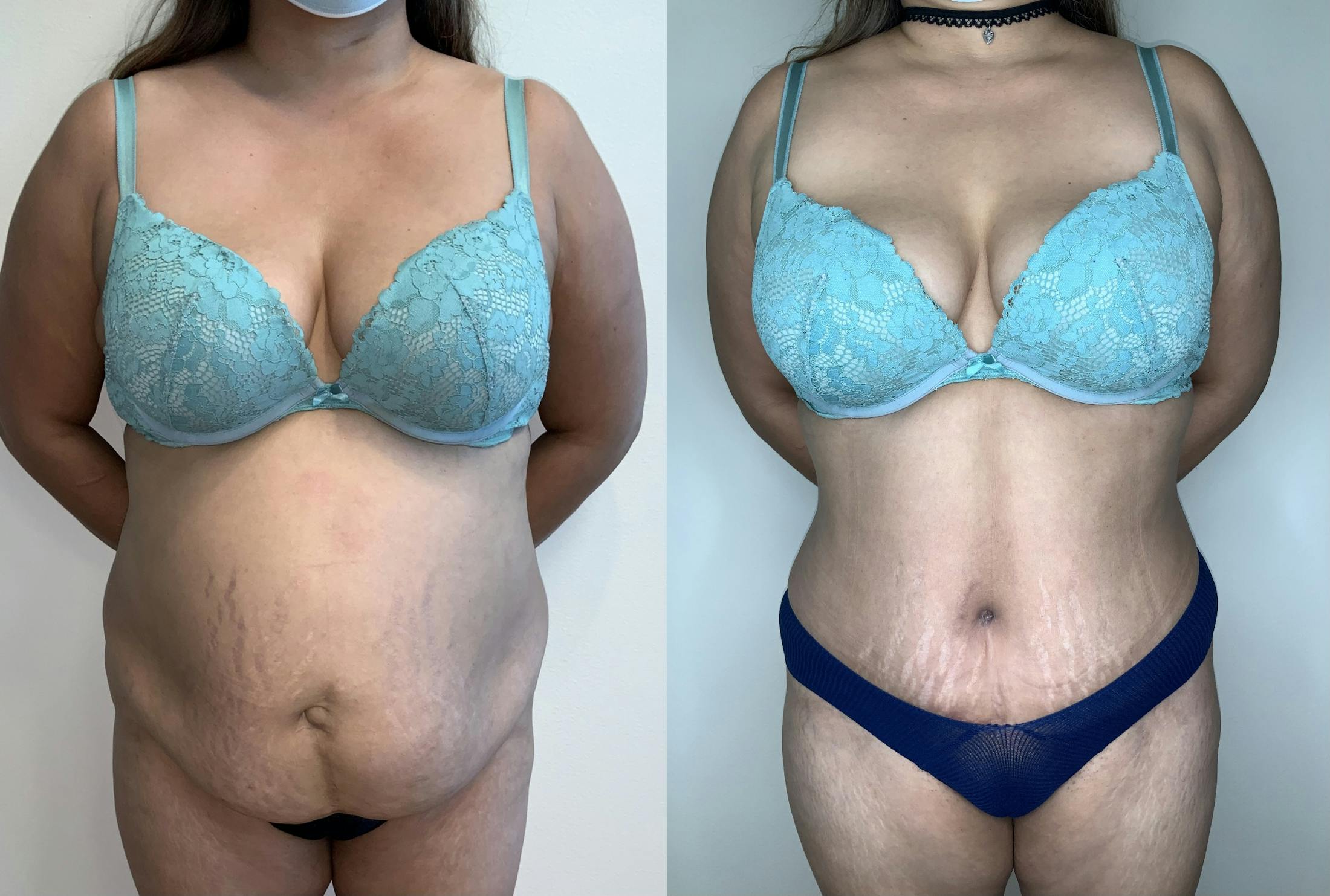 Tummy Tuck Before & After Gallery - Patient 54039195 - Image 1