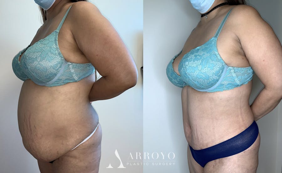 Tummy Tuck Before & After Gallery - Patient 54039195 - Image 2