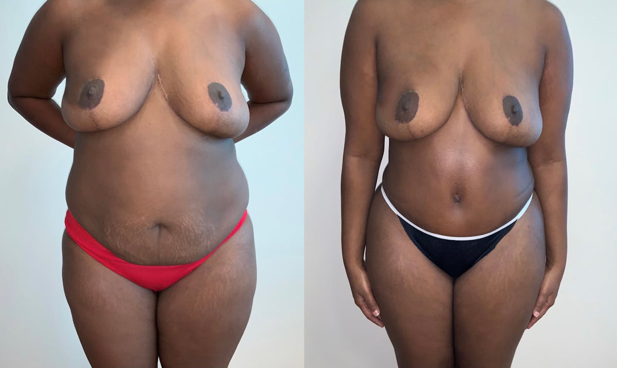 Tummy Tuck Before & After Gallery - Patient 54039383 - Image 1