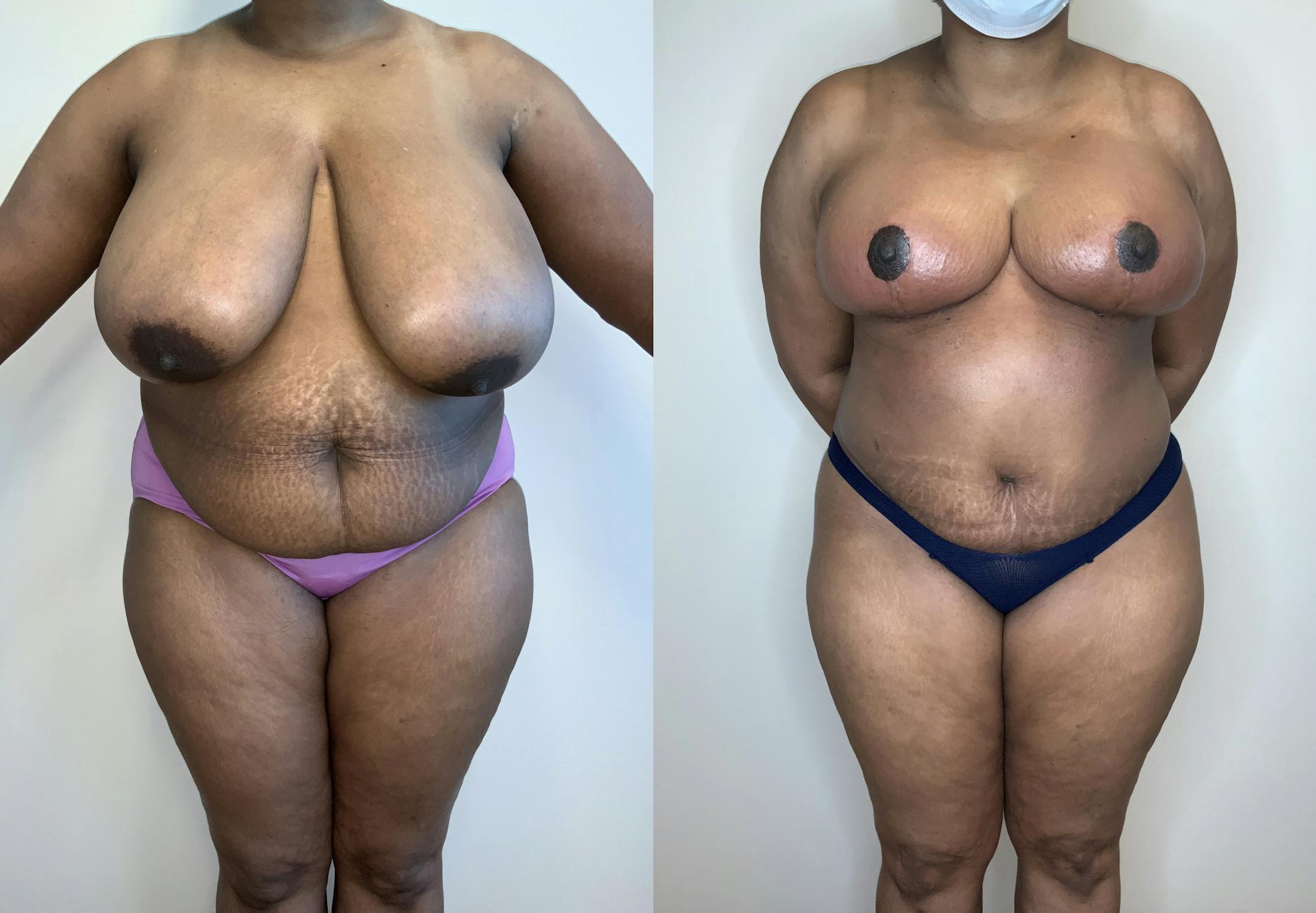 Breast Reduction Gallery - Patient 54039492 - Image 1