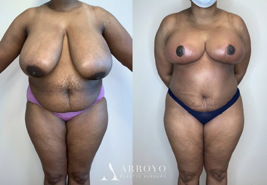 Tummy Tuck Before & After Gallery - Patient 54039384 - Image 1