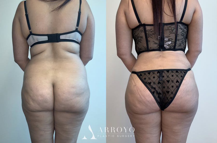 Tummy Tuck Before & After Gallery - Patient 54039385 - Image 3