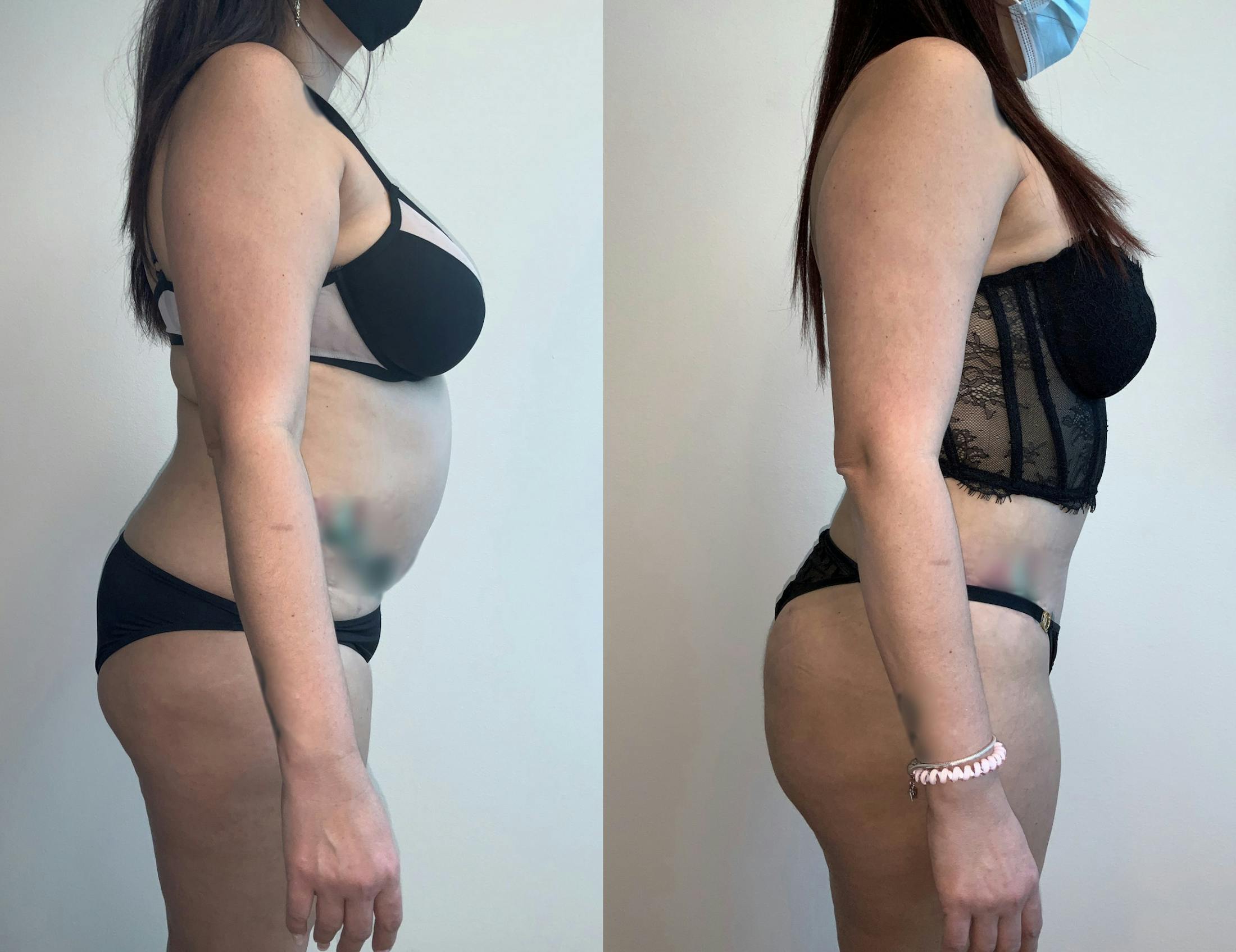 Tummy Tuck Gallery - Patient 54039385 - Image 2