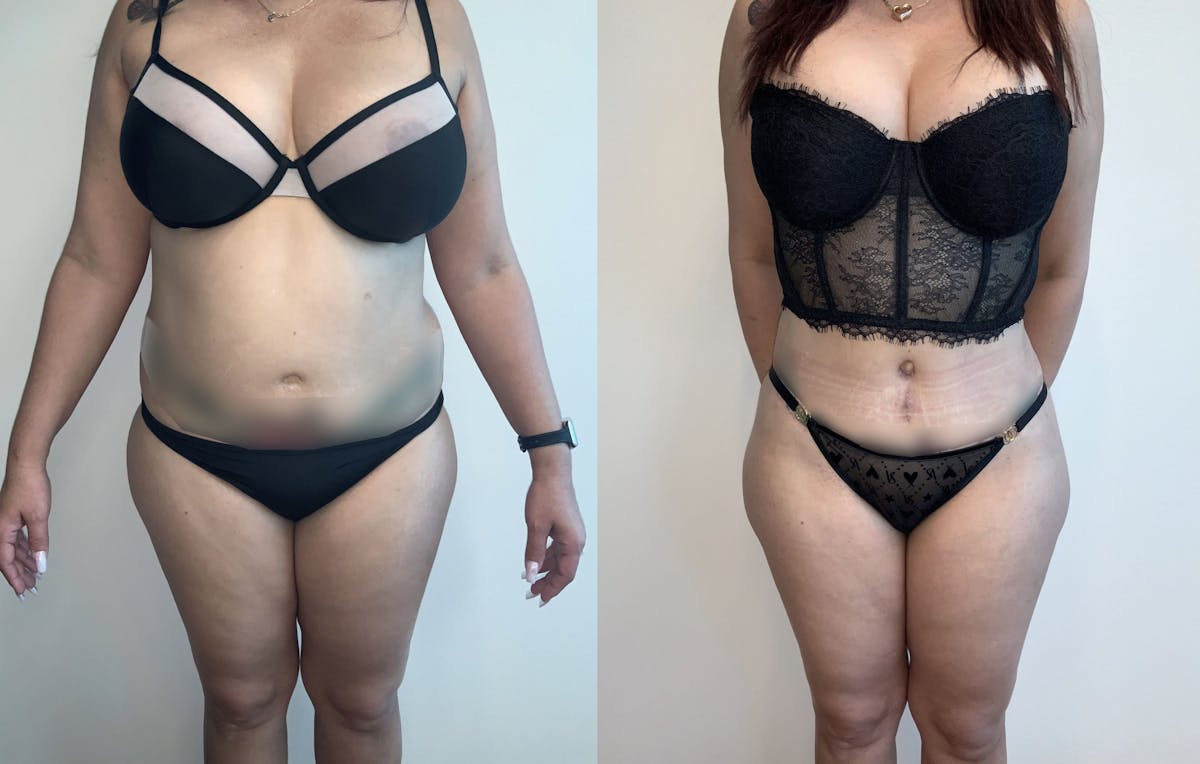Tummy Tuck Before & After Gallery - Patient 54039385 - Image 1