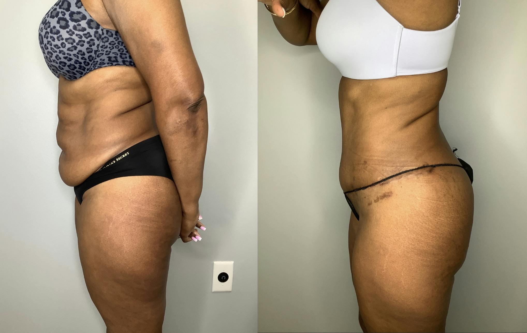 Liposuction Before & After Gallery - Patient 57580351 - Image 3