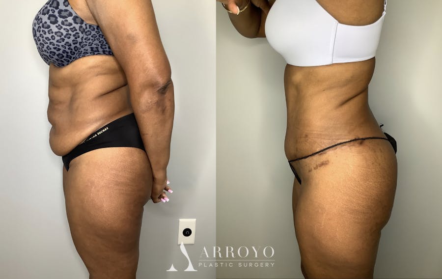 Tummy Tuck Before & After Gallery - Patient 57580348 - Image 3