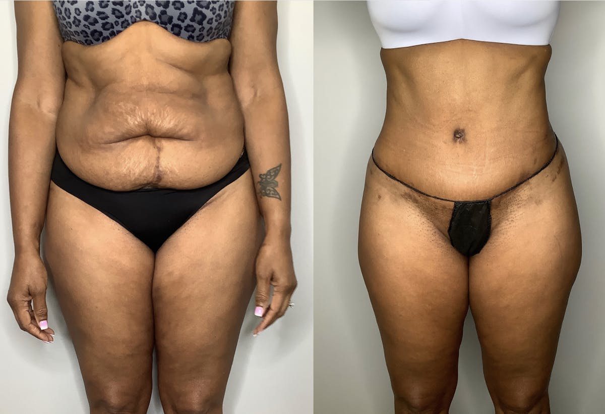 Liposuction Before & After Gallery - Patient 57580351 - Image 5