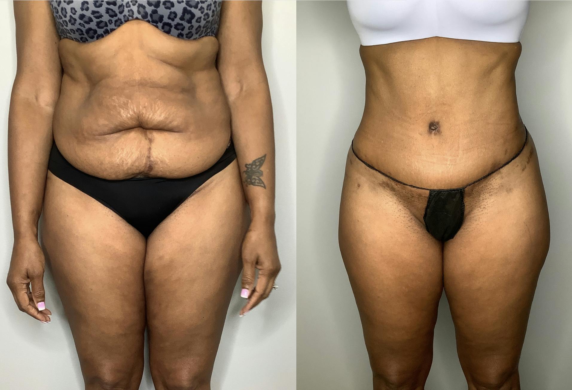 Tummy Tuck Before & After Gallery - Patient 57580348 - Image 5
