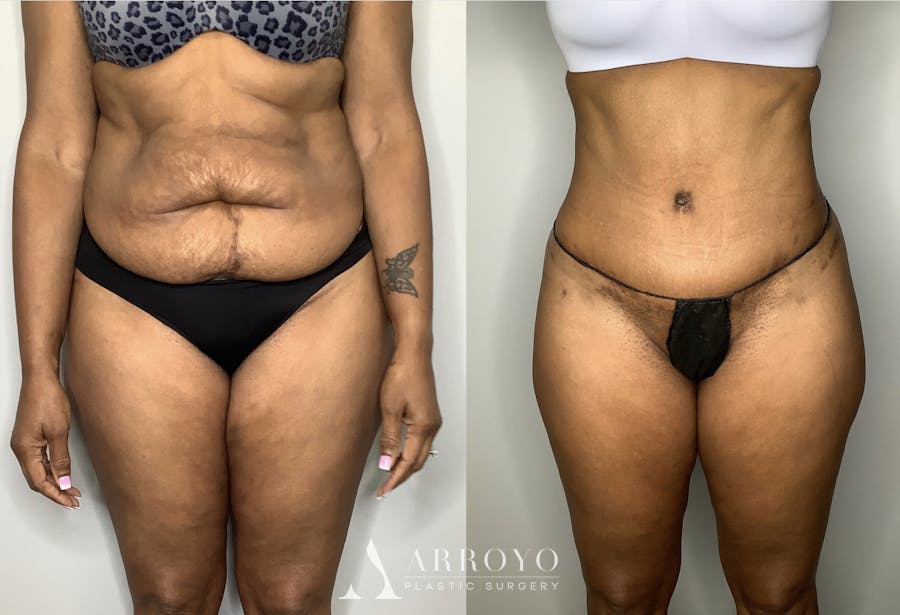 Tummy Tuck Before & After Gallery - Patient 57580348 - Image 5