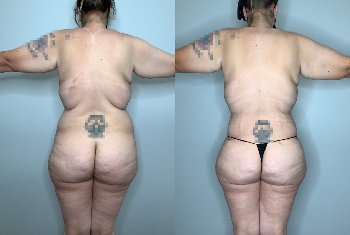 Liposuction Before & After Gallery - Patient 59474627 - Image 4