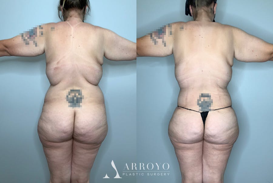 Brazilian Butt Lift Before & After Gallery - Patient 59474630 - Image 1